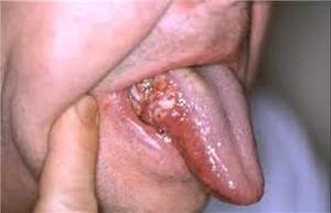 تشخیص زودهنگام سرطان‌های دهان، افزایش شانس درمان